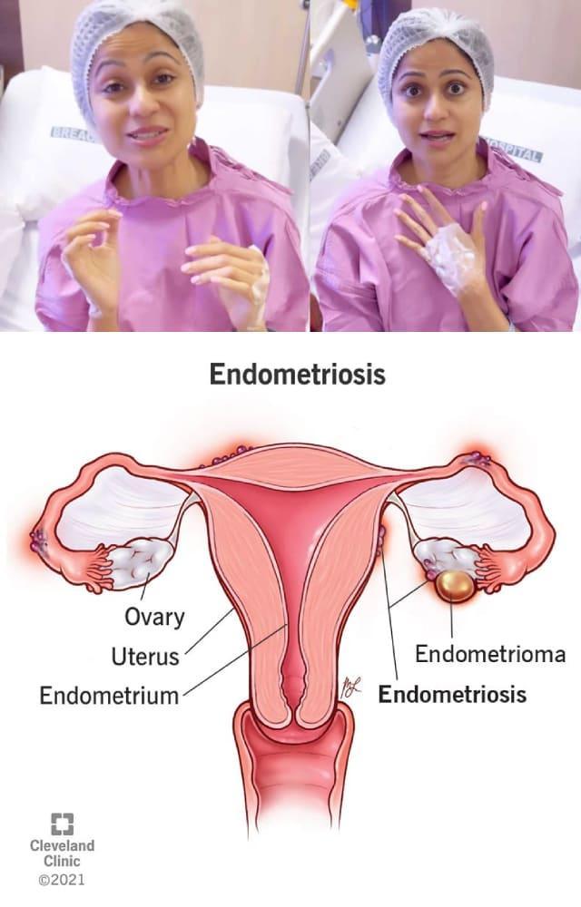 What Is Endometriosis? Symptoms & Causes