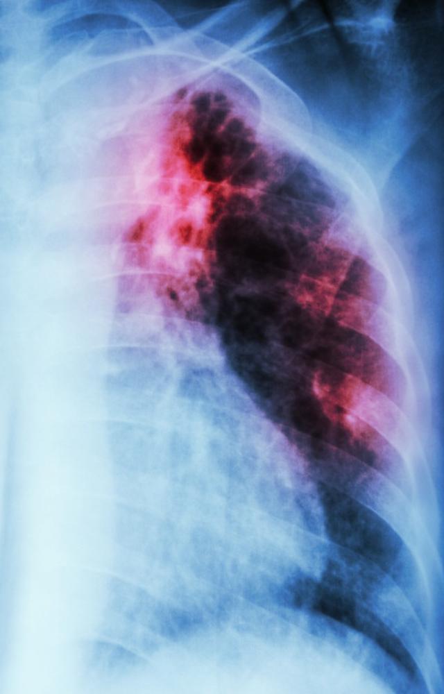 Idiopathic pulmonary fibrosis (IPF) is a serious chronic disease that affects the tissue surrounding the air sacs (alveoli) in the lungs.