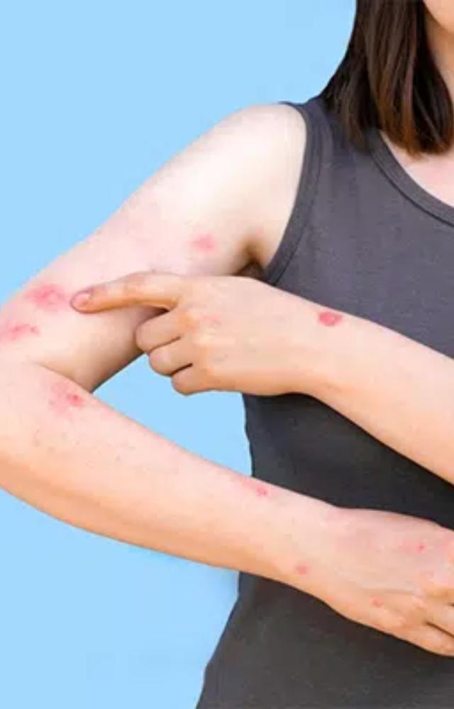 Things You Should Know About Monkeypox