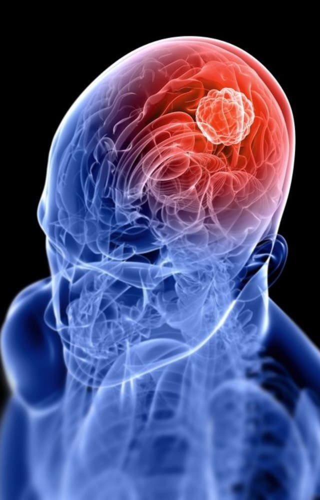 With Bibek Pangeni news trending all over, let`s understand this condition. Glioma is a group of cancerous tumours that develop in the brain and spinal cord.