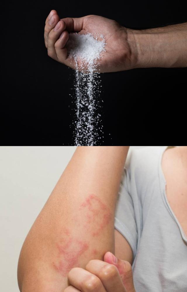 A lot of consumption of salt can lead to skin issues like dryness or itchiness, as salt can dehydrate the skin and disturb its natural balance