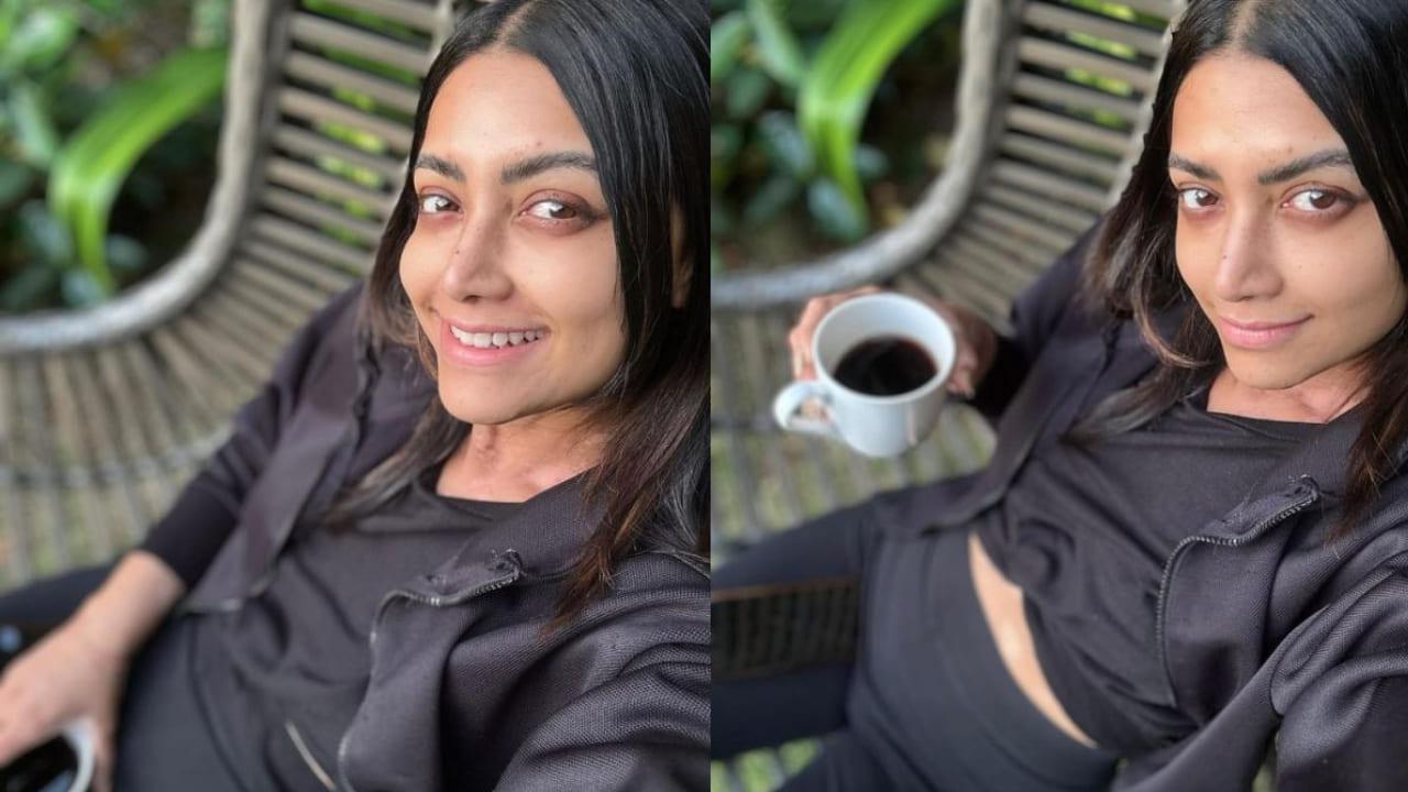 South Actress Mamta Mohandas Diagnosed With Autoimmune Vitiligo, Pens Down An Emotional Post