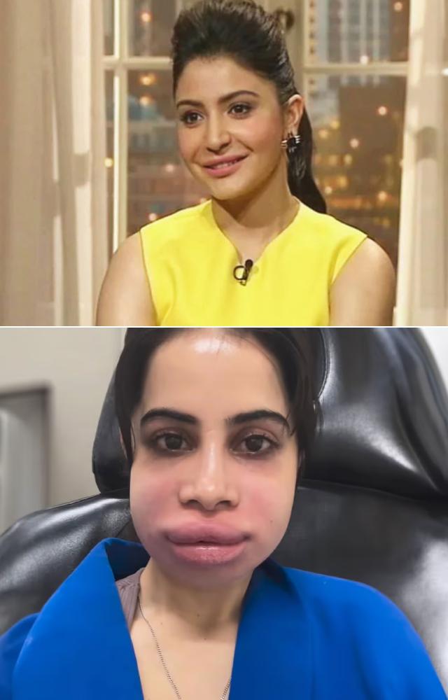 10 Actresses Who Underwent Lip Surgeries