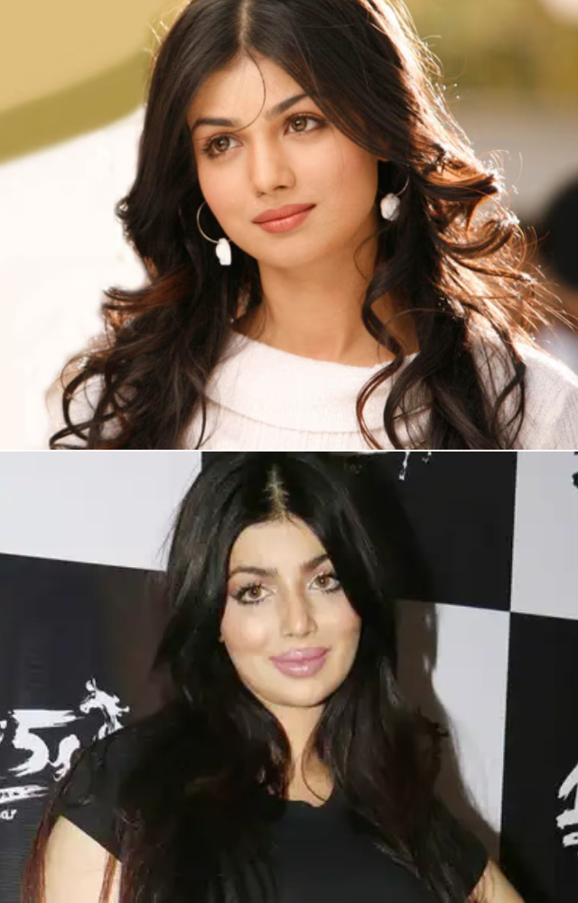 Comparing her before and after photos, it is pretty evident Ayesha has undergone cosmetic surgeries, including lip fillers and rhinoplasty.