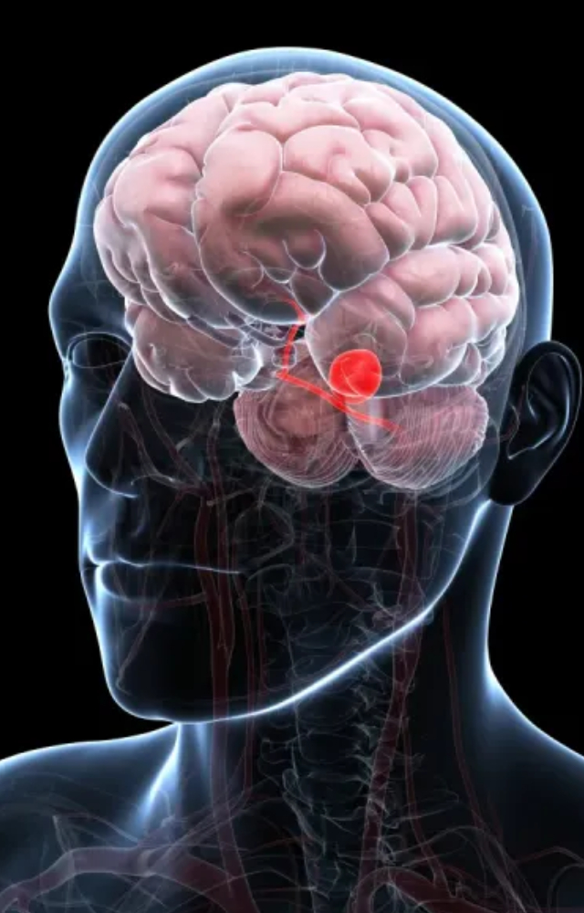 A brain aneurysm (also known as a cerebral aneurysm) is a bulge or ballooning in a blood vessel in the brain. If ruptured, it can turn deadly.