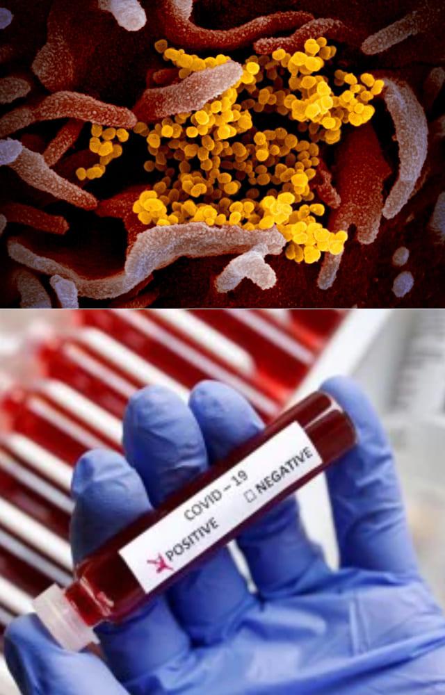 HMPV vs Covid: Similarity & Differences 