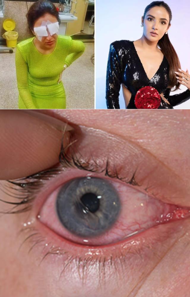 What is Corneal Damage? Signs And Causes