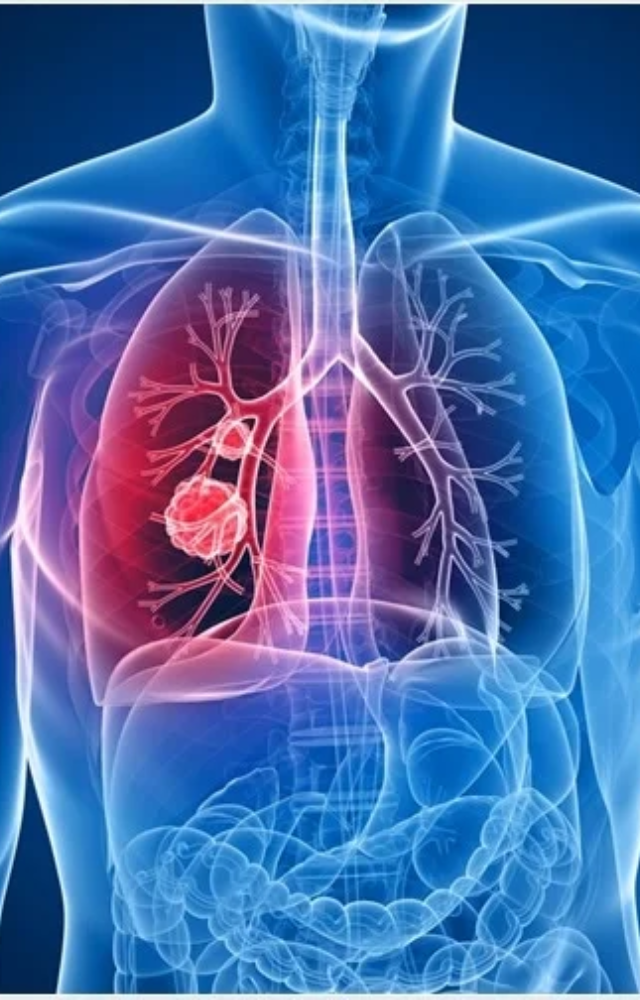 7 Things to Know About Lung Cancer