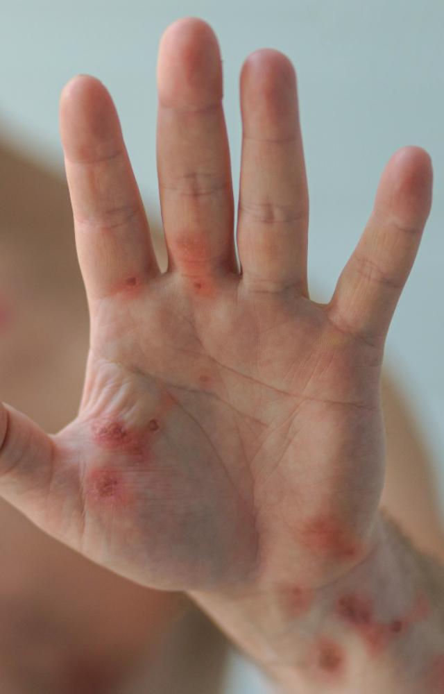 Primarily, it spreads through close contact with an infected person`s rash, scabs, or bodily fluids. It can also spread through respiratory droplets.