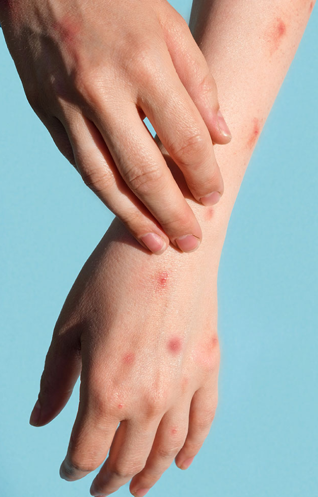 Often start with fever, headache, muscle aches, backache, chills, and fatigue. A face rash can appear, which can spread to other parts of the body.