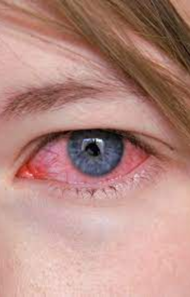 Tips to Avoid Conjuctivitis in Monsoon