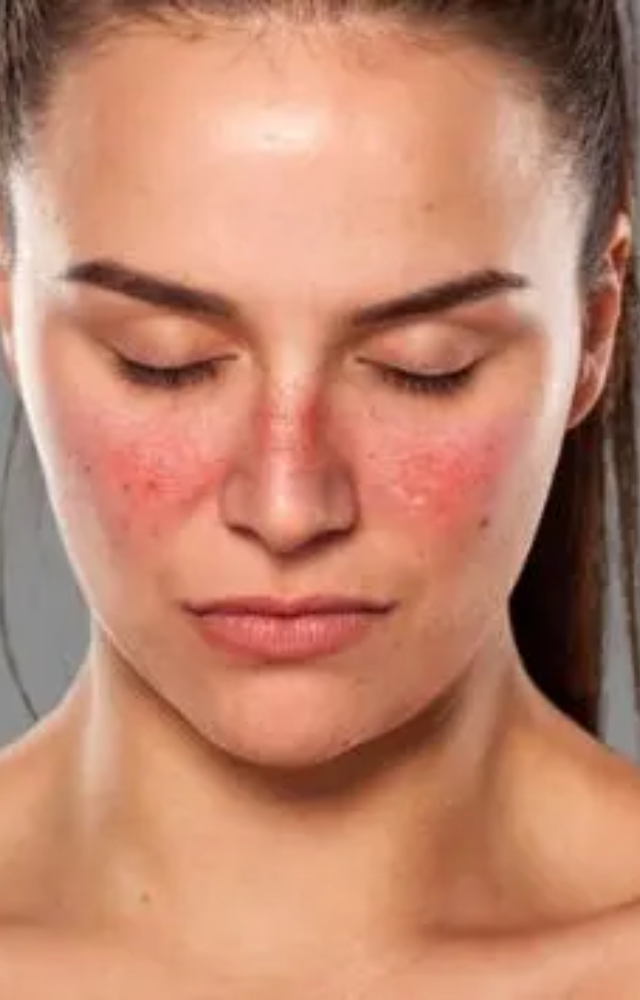 What is Systemic Lupus Erythematosus?