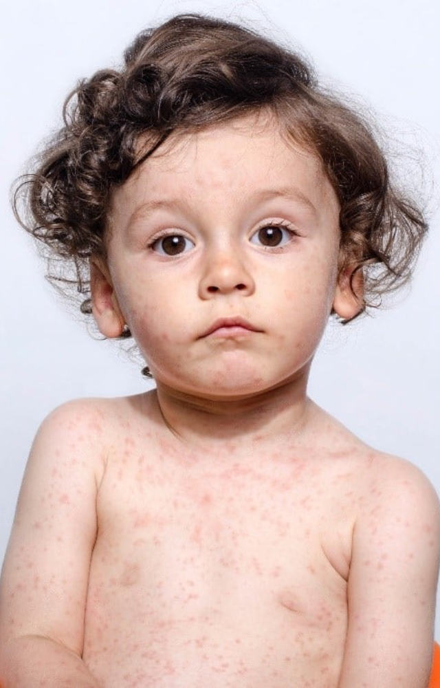 Mumps is indeed most common in young children, typically between 2 and 12 years old.