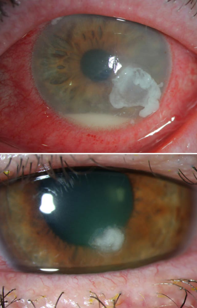 Let`s understand more about the condition. It happens when the clear tissue covering the front of an eye to focus on the image is damaged.