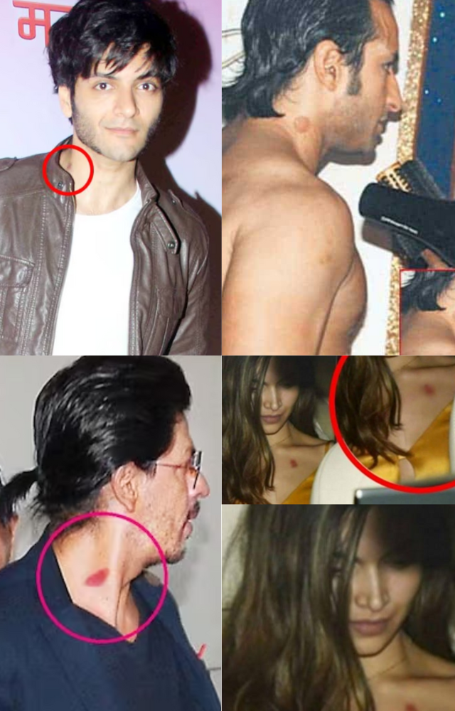5 Celebrities Spotted with hickeys